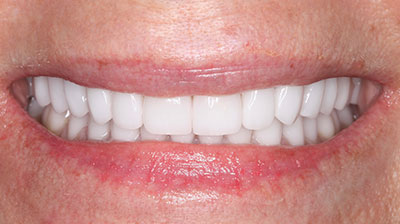 before after photo