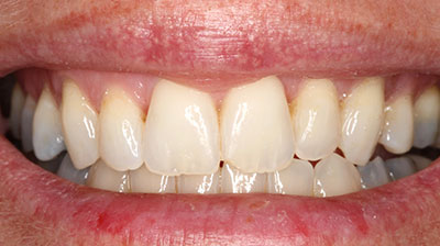 before after photo