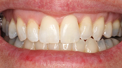 before after photo