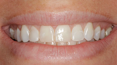 before after photo