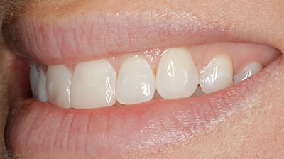 before after photo