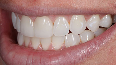 before after photo