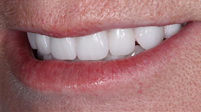 before after photo