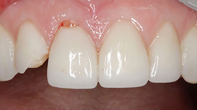 before after photo