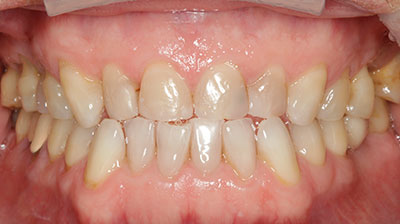 before after photo