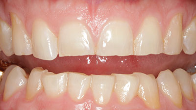 before after photo