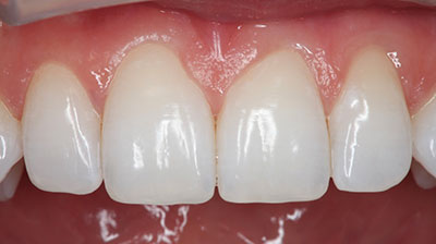 before after photo