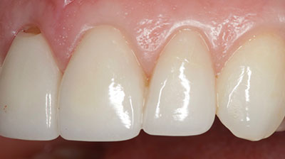 before after photo