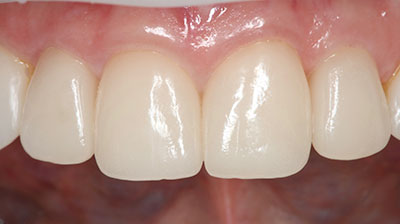 before after photo