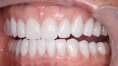 before after photo