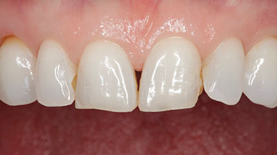 before after photo