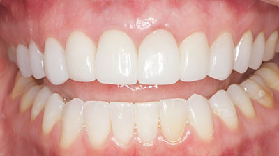 before after photo