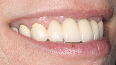 before after photo