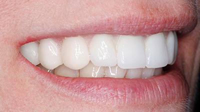 before after photo