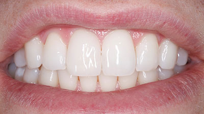 before after photo
