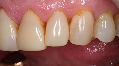 before after photo