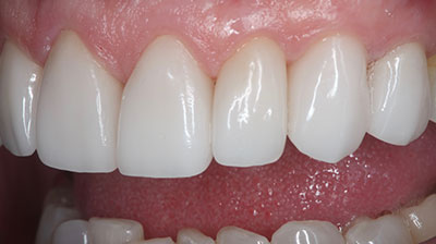 before after photo