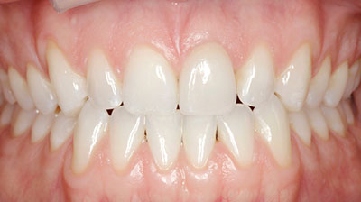 before after photo