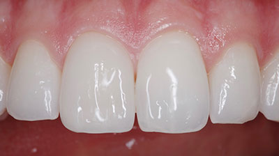 before after photo